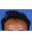 Before Hair Transplant &nbsp;Front